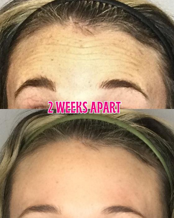 Botox and Xeomin Before and After Forehead Lines At Moore Smiles in Sweetwater, TN by Dr. Christy Moor