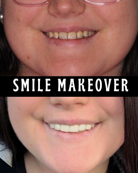 Smile Makeover Before and After images