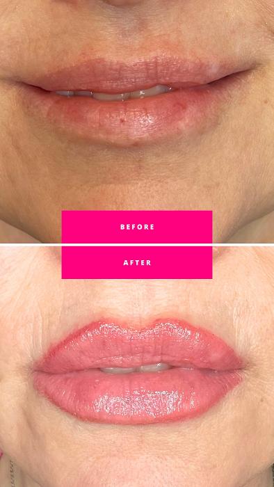 Lip Filler Before and After by Dr. Christy Moore. In Sweetwater,TN at Moore Smiles