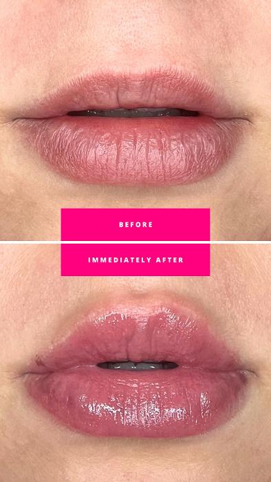 Lip Filler Before and After, Sweewater, TN