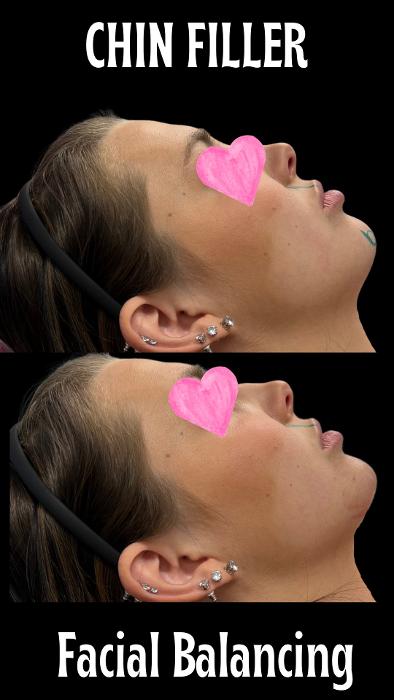 Facial Balancing at Moore Smiles, Dr.Christy in Sweetwater, TN. Before and After pictures. Chin filler