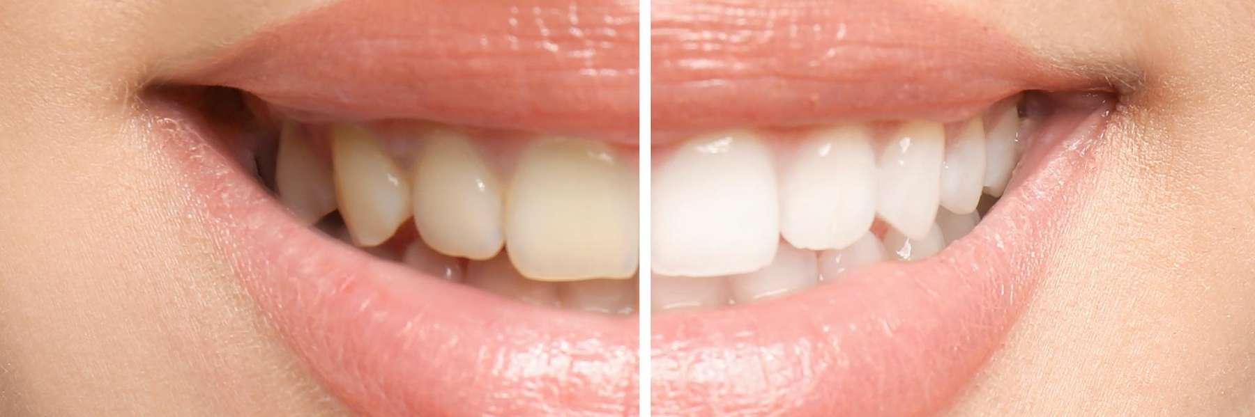 teeth whitening results in sweetwater, TN
