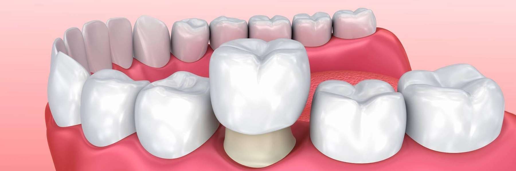 full smile makeovers include dental crowns