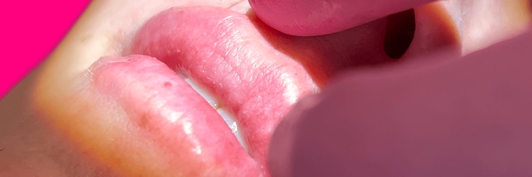 Woman getting lip filler in Sweetwater