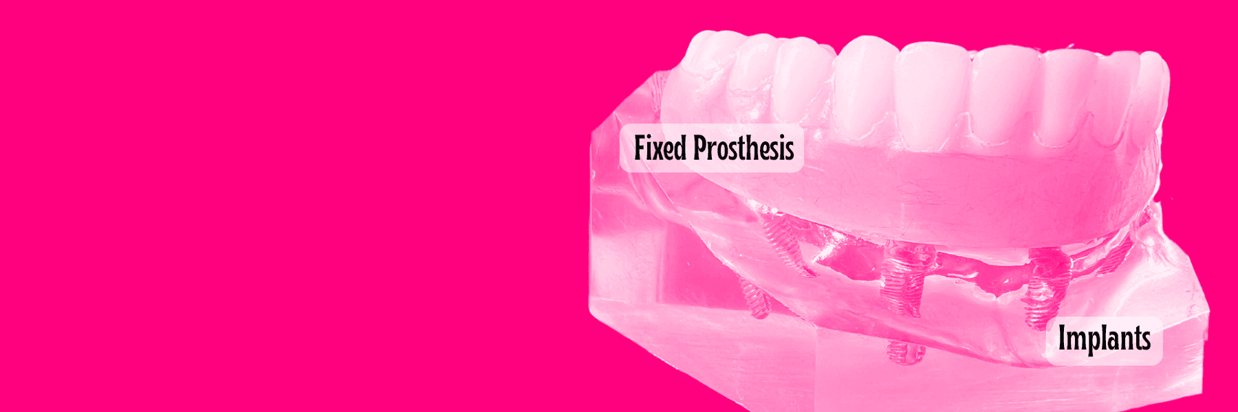 implant supported denture sweetwater