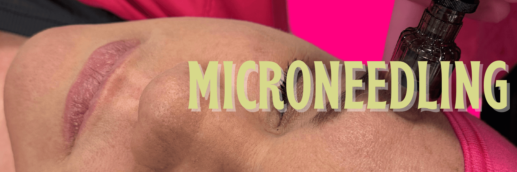 microneedling sweetwater