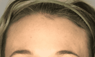 botox after treatment in sweetwater