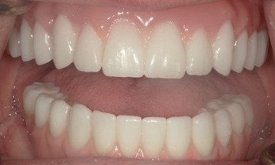 After treatment - Her Grandkids Can See Her Smile Again | Hybrid Denture Smile Transformation
