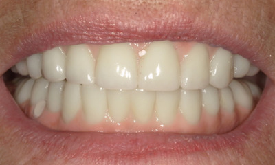 After treatment - Implant Supported Smile Makeover-Hybrid Implant Dentures