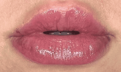 After fillers in sweetwater