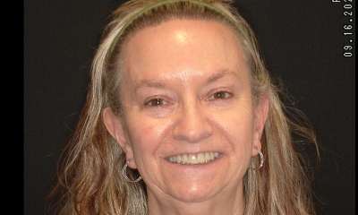 Microneedling-After-Image