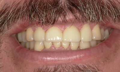after Restoring Function and Improving Airway in sweetwater