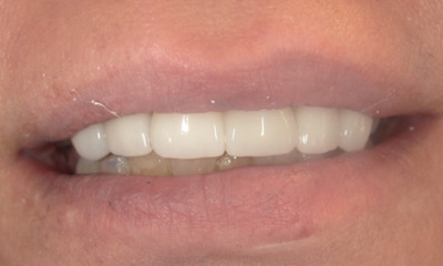 After treatment - Smile Makeover After Front Tooth Extraction | Dental Bridge & Crowns