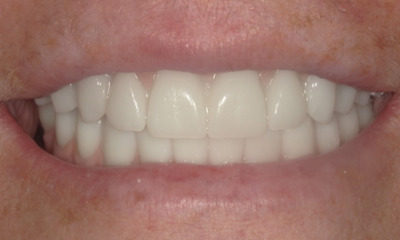 After treatment - Her Grandkids Can See Her Smile Again | Hybrid Denture Smile Transformation