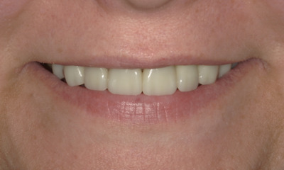 After photo of full smile makeover. front 8 teeth crowned.