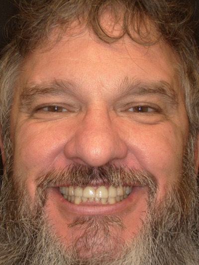 after smile makeover to Restore Function and Improve Airway in sweetwater