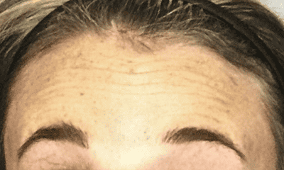 botox before treatment in sweetwater