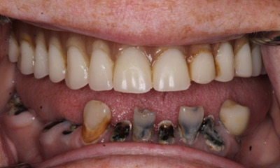 Before treatment - Her Grandkids Can See Her Smile Again | Hybrid Denture Smile Transformation