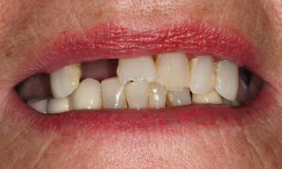 Before treatment - Implant Supported Smile Makeover-Hybrid Implant Dentures