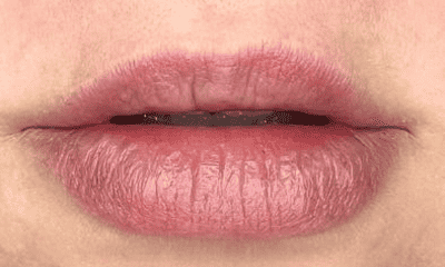 Before fillers in sweetwater