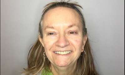 Microneedling-Before-Image