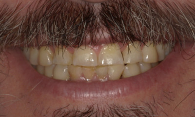 before Restoring Function and Improving Airway in sweetwater