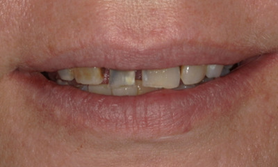 Before treatment - Smile Makeover After Front Tooth Extraction | Dental Bridge & Crowns