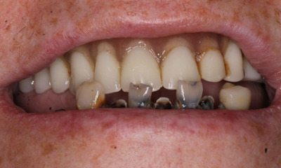 Before treatment - Her Grandkids Can See Her Smile Again | Hybrid Denture Smile Transformation