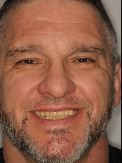 before smile makeover to Restore Function and Improve Airway in sweetwater